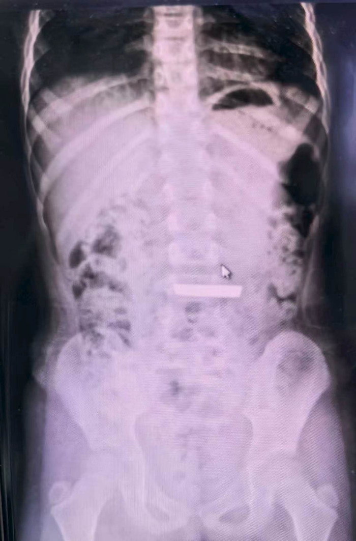 Bé gái 5 tuổi nuốt thỏi vàng 50 gram vào bụng, bác sĩ kinh ngạc khi siêu âm Ảnh 1