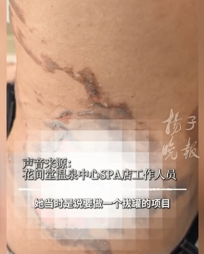 Đi giác hơi tại khách sạn, cô gái trẻ gặp sự việc kinh hoàng Ảnh 2