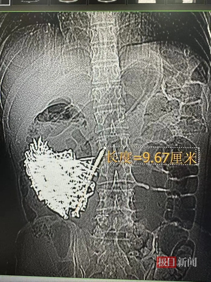 Người đàn ông bị đau bụng liên tục, bác sĩ bàng hoàng khi lấy ra thứ từ trong dạ dày Ảnh 2
