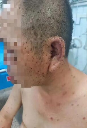 Người đàn ông bị đàn ong tấn công, bác sĩ mất 3 tiếng mới lấy hết 1.000 ngòi độc Ảnh 1