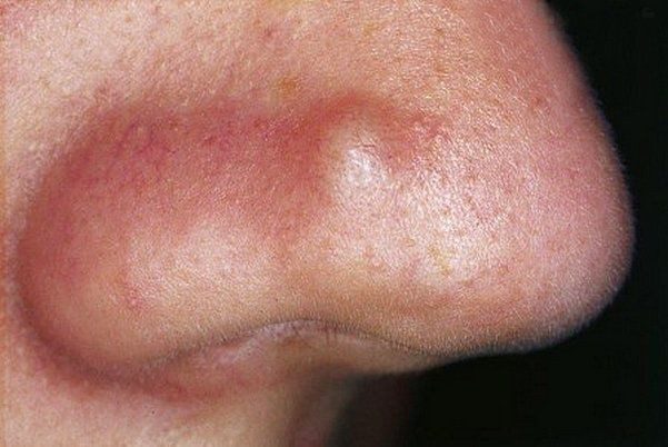 Nổi mụn ở từng vị trí trên mặt nói lên điều gì? Ảnh 4