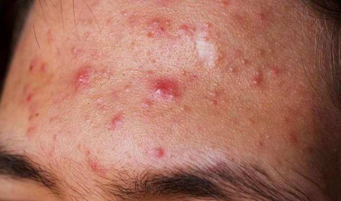 Nổi mụn ở từng vị trí trên mặt nói lên điều gì? Ảnh 1