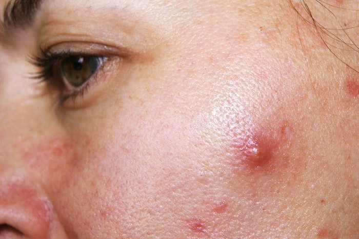 Nổi mụn ở từng vị trí trên mặt nói lên điều gì? Ảnh 2