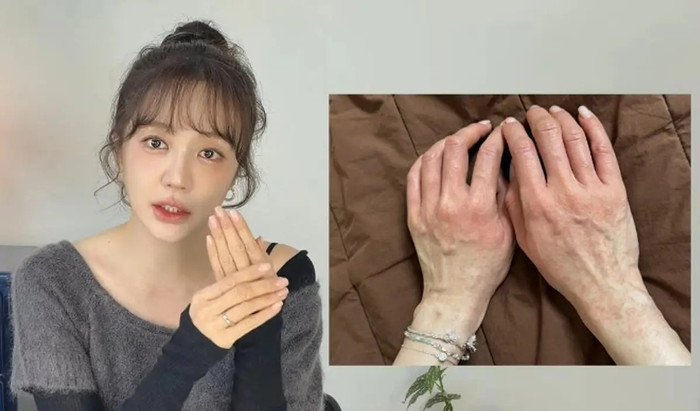 Yoon Eun Hye cho biết từng bị dị ứng nghiêm trọng suốt 3 tuần.&nbsp;