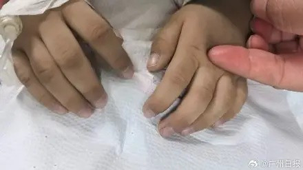 Bé trai 3 tuổi tím tái toàn thân, bác sĩ tìm ra nguyên nhân khiến nhiều phụ huynh giật mình Ảnh 1
