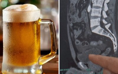 Vỡ bàng quang vì không đi tiểu suốt 18 tiếng sau khi uống 10 cốc bia Ảnh 2