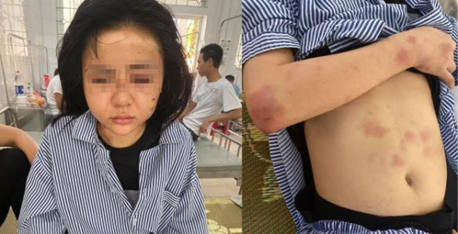 Những vết thương trên cơ thể chị L.