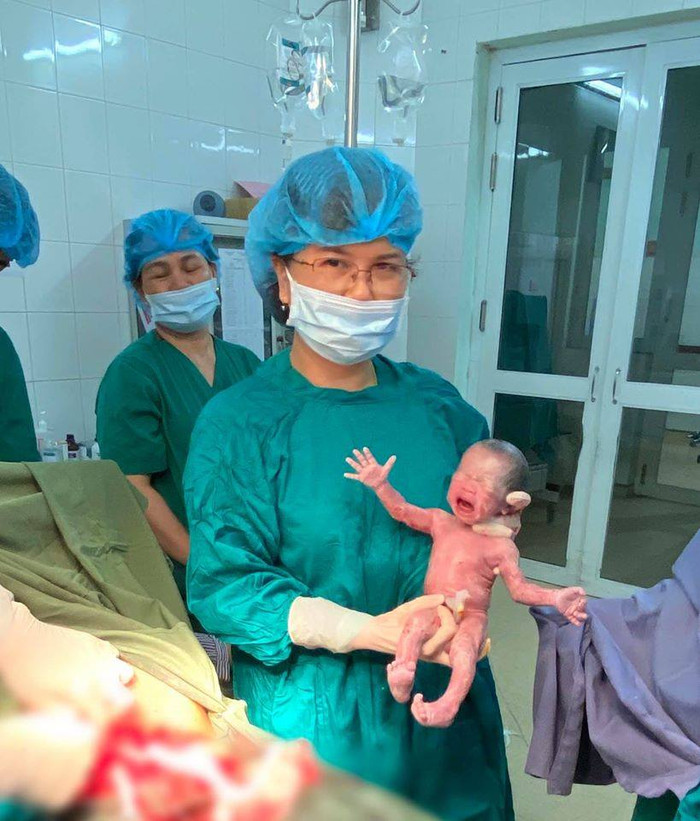 Bác sĩ thực hiện phẫu thuật lấy thai ca sinh 3 cùng trứng hy hữu.&nbsp;