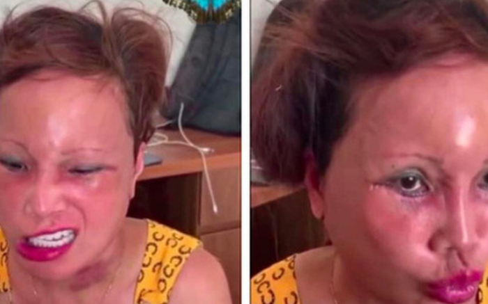 Cô dâu 63 tuổi lại khiến dân tình 'tá hỏa' vì khuôn mặt biến chứng sau phẫu thuật Ảnh 2