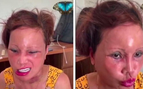 Diện mạo mới nhất của 'cô dâu 62 tuổi' sau thời gian bị biến chứng do phẫu thuật thẩm mỹ làm căng da mặt Ảnh 4