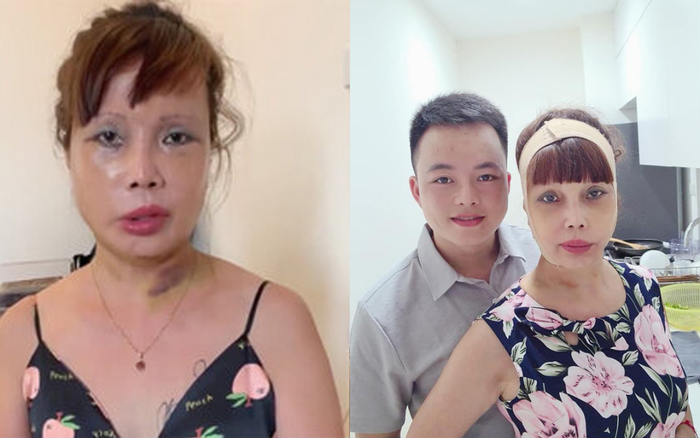 Diện mạo mới nhất của 'cô dâu 62 tuổi' sau thời gian bị biến chứng do phẫu thuật thẩm mỹ làm căng da mặt Ảnh 2