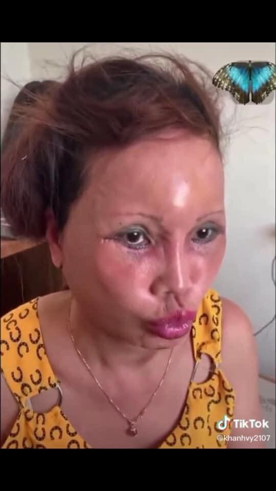 Ngồi cạnh chồng trẻ với gương mặt ngày càng đơ, cô dâu 63 tuổi khiến dân tình vừa ngán ngẩm, vừa thương cảm Ảnh 4