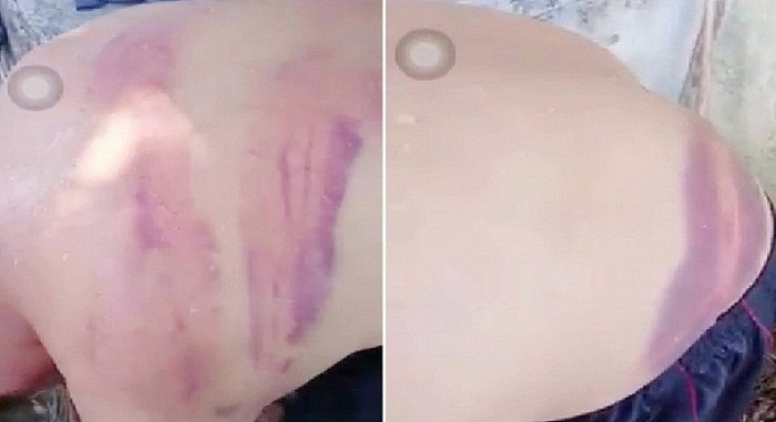 Hình ảnh nhiều vết bầm tím trên lưng người đàn ông khiến dư luận xôn xao. Ảnh cắt từ clip