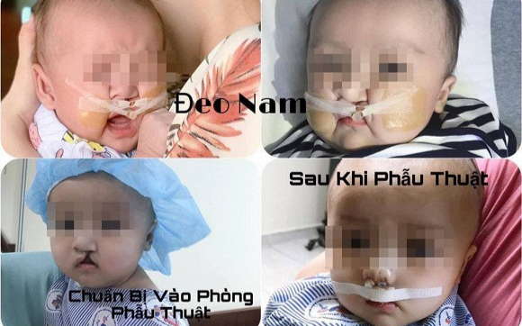 Được khuyên bỏ thai vì em bé hở hàm ếch, bà mẹ trẻ vẫn quyết tâm giữ lại con và cái kết khiến nhiều người xúc động Ảnh 2