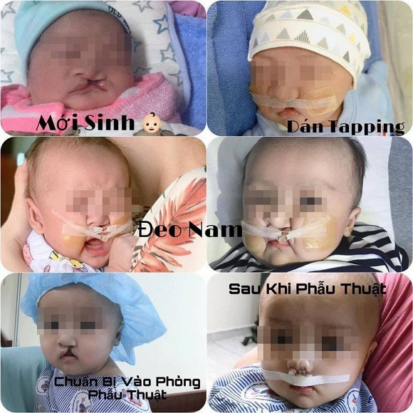 Được khuyên bỏ thai vì em bé hở hàm ếch, bà mẹ trẻ vẫn quyết tâm giữ lại con và cái kết khiến nhiều người xúc động Ảnh 4