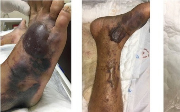 Những ai có thể nhiễm khuẩn 'ăn thịt người’ và dễ mất mạng khi ăn hàu sống? Ảnh 2