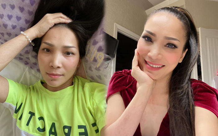 Hồng Ngọc khoe cận nhan sắc rạng rỡ sau khi bỏng nặng nhưng lại để lộ một số thương tích khó lành Ảnh 2