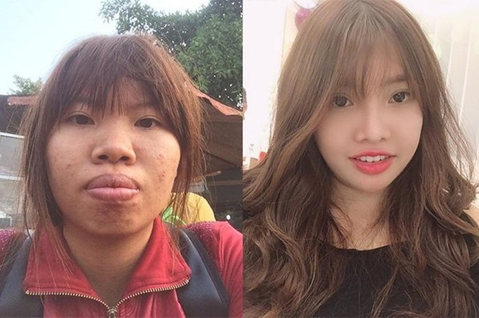 Quách Phượng trước và sau khi phẫu thuật thẩm mĩ 