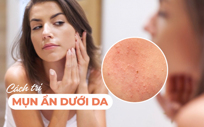 Cách trị mụn ẩn dưới da đơn giản mà hiệu quả không ngờ Ảnh 2