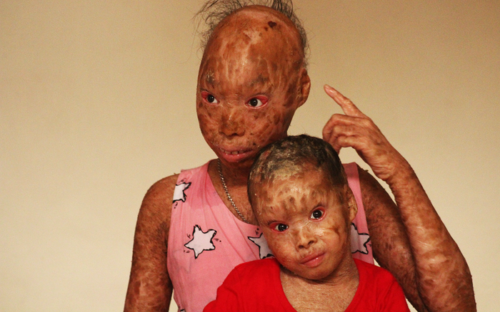 Nỗi xót xa của hai chị em gái mắc bệnh quỷ ám: Em thích được đi học nhưng các bạn nhìn thấy đều bảo là con ma nên em sợ lắm' Ảnh 2