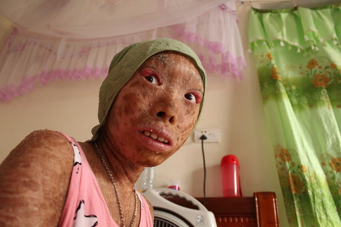 &nbsp;Bé Thảo phải chịu nhiều sự kỳ thị của bạn bè, cuộc đời do mắc bệnh.