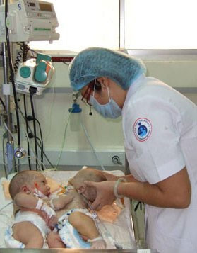 Hai bé sơ sinh 16 ngày tuổi bị dính liền gan.