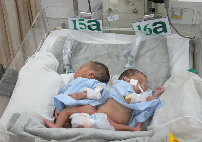 Hai bé gái dính liền phần mông trước khi phẫu thuật tách rời.