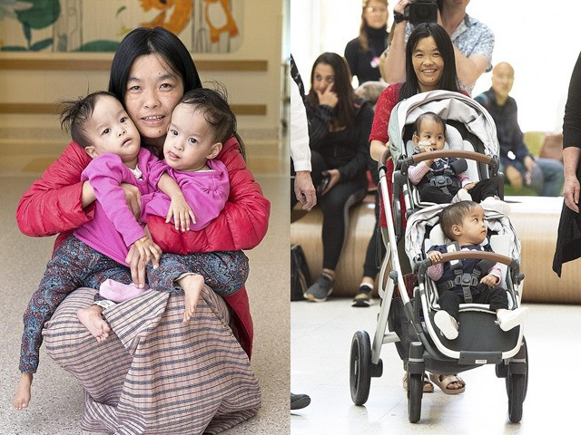 Hai bé Nima và Dawa trước và sau khi được tách rời.