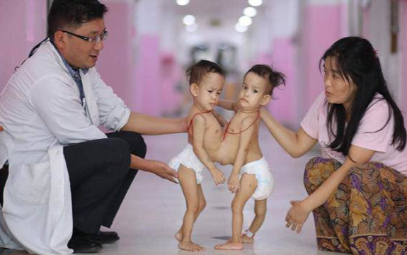 Kỳ diệu những ca phẫu thuật tách rời thành công cặp song sinh dính liền trên thế giới Ảnh 2