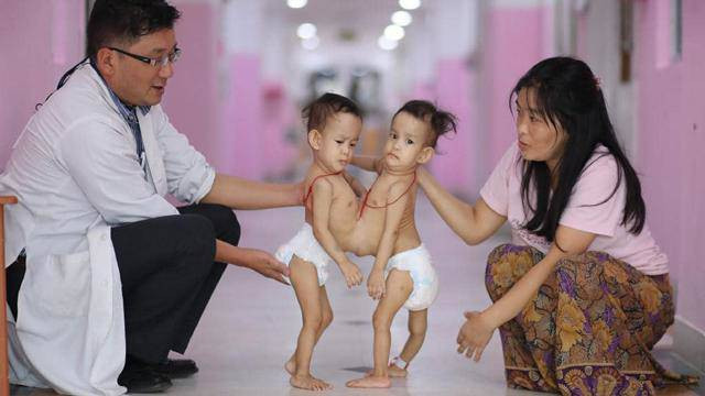 Bé Nima và Dawa bị dính liền vào nhau.