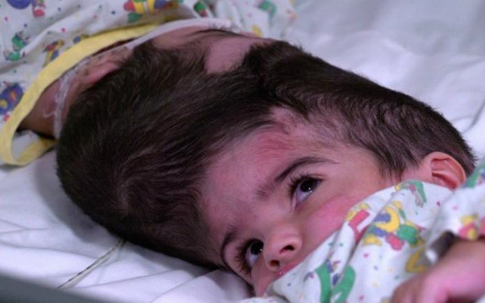 Safa và Marwa bị dính liền đầu.