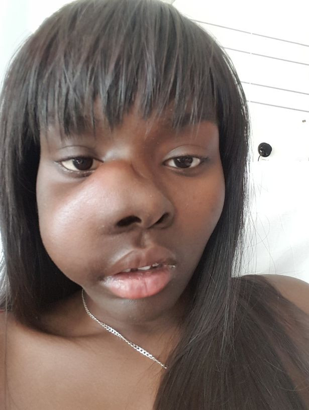 Nghị lực sống phi thường của cô gái ung thư xương bị biến dạng mặt Ảnh 6