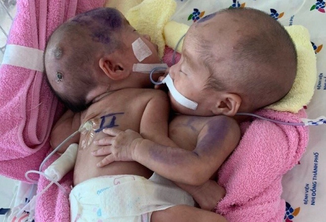 Hai bé sơ sinh dính liền, dùng chung một bỉm. Ảnh: Phương Vũ.