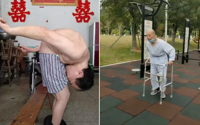 Mắc bệnh lạ, người đàn ông phải cúi gập người suốt 25 năm Ảnh 2