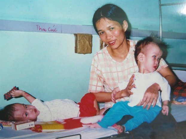 Cặp song sinh Cúc - An khi dính vào nhau và thời điểm sau khi được tách rời.