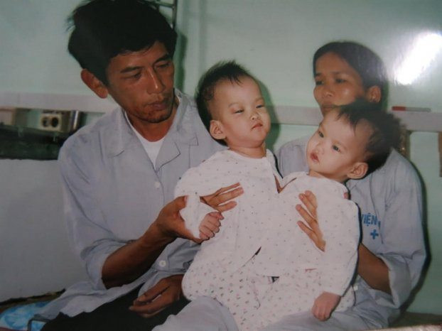 Cặp song sinh Cúc -An từng dính liền vào nhau cách đây gần 20 năm hồi sinh kỳ diệu, xinh đẹp ngỡ ngàng Ảnh 5