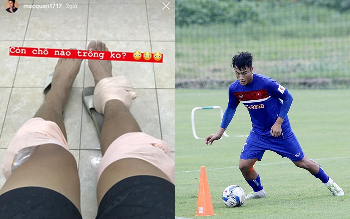 Mạc Hồng Quân băng bó kín chân Ảnh 2