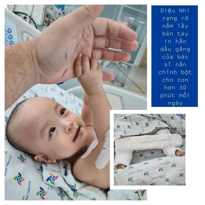 Bé Diệu Nhi rạng rỡ nắm lấy bàn tay bác sĩ đã chỉnh bột cho mình Ảnh 3