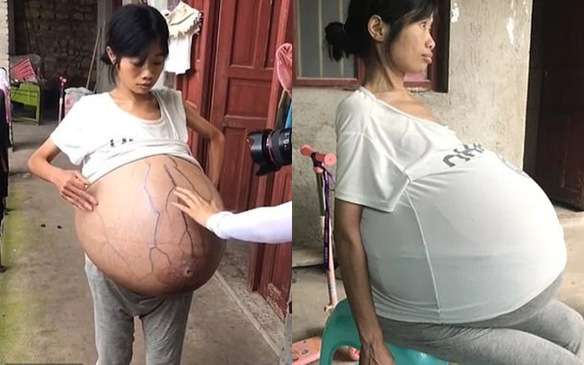 Người phụ nữ khổ sở với bụng nặng gần 20 kg và không ngừng to Ảnh 2
