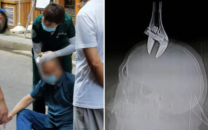 Bị cờ lê rơi từ tầng 8 xuyên thủng hộp sọ, người đàn ông vẫn sống sót thần kỳ Ảnh 2