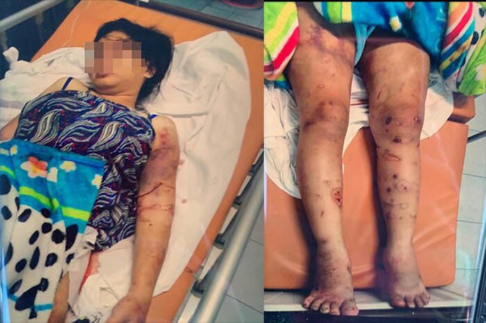 Các vết thương của nạn nhân do bị nhóm côn đồ tra tấn dã man. Ảnh: báo Tổ Quốc