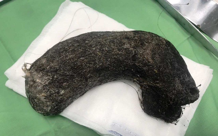 Phát hiện búi tóc 'khủng' trong dạ dày bé gái 11 tuổi Ảnh 2