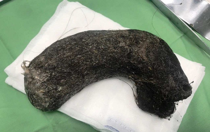 Búi tóc “khủng” trong dạ dày bệnh nhi 11 tuổi