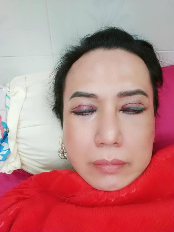 Hậu phẫu thuật thẩm mỹ, 'cô Minh Hiếu' lần đầu livestream với ngoại hình khác lạ Ảnh 6