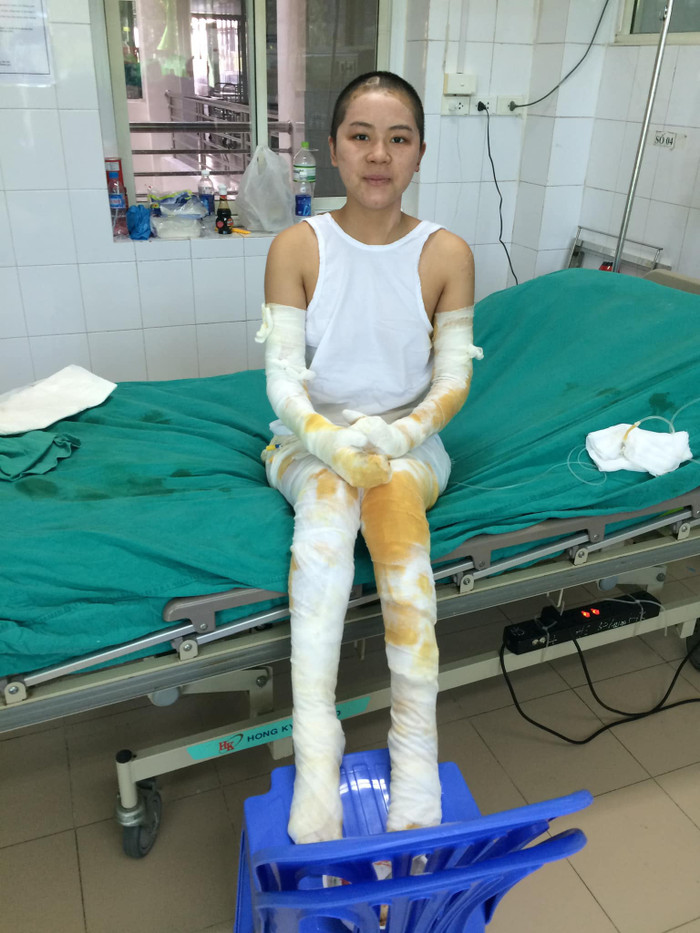 Trang từng trải qua những chuỗi ngày đầy đau đớn vì bị bỏng.