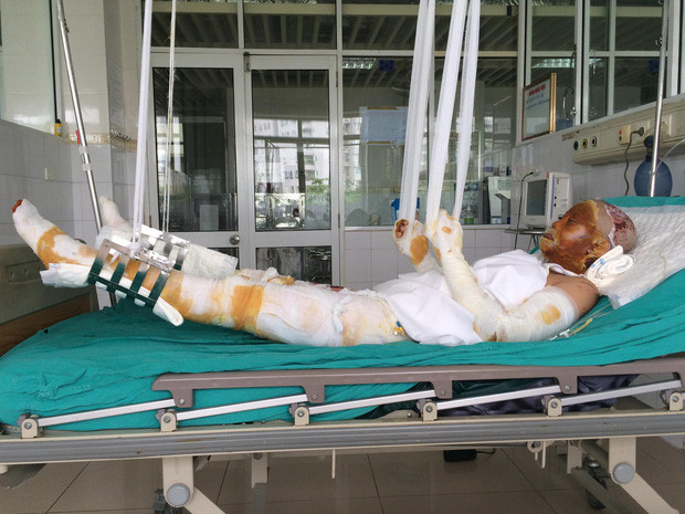 Nữ giáo viên xinh đẹp vượt qua cú sốc bị bỏng nặng vì nổ bóng bay: 'Tôi đã chọn cuộc sống vui vẻ, để sau này già đi sẽ không hối tiếc' Ảnh 3