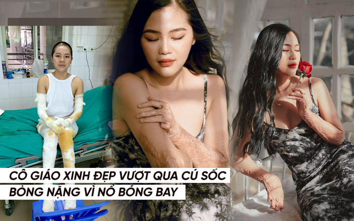 Nữ giáo viên xinh đẹp vượt qua cú sốc bị bỏng nặng vì nổ bóng bay: 'Tôi đã chọn cuộc sống vui vẻ, để sau này già đi sẽ không hối tiếc' Ảnh 2
