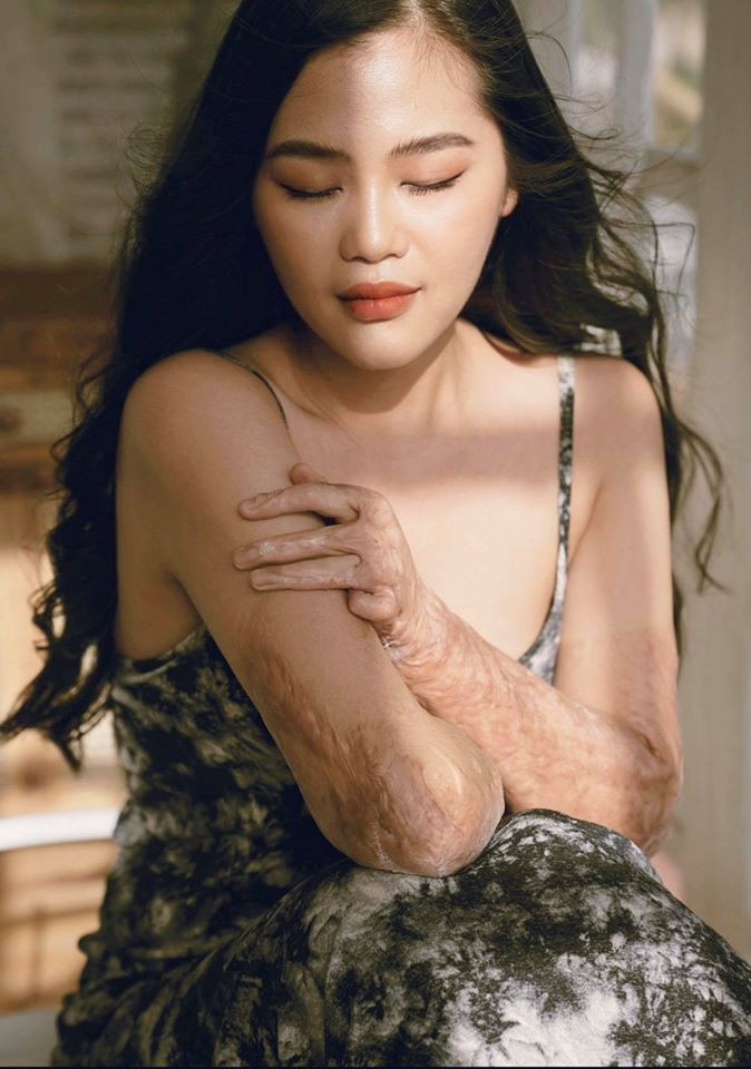 Có lúc Trang tự ti với vẻ bề ngoài, không dám tiếp xúc với bất kỳ ai.