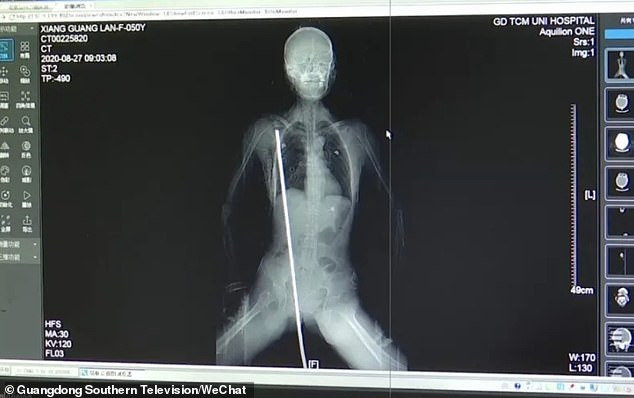 Người phụ nữ họ Tương bị thanh thép đâm xuyên cơ thể.