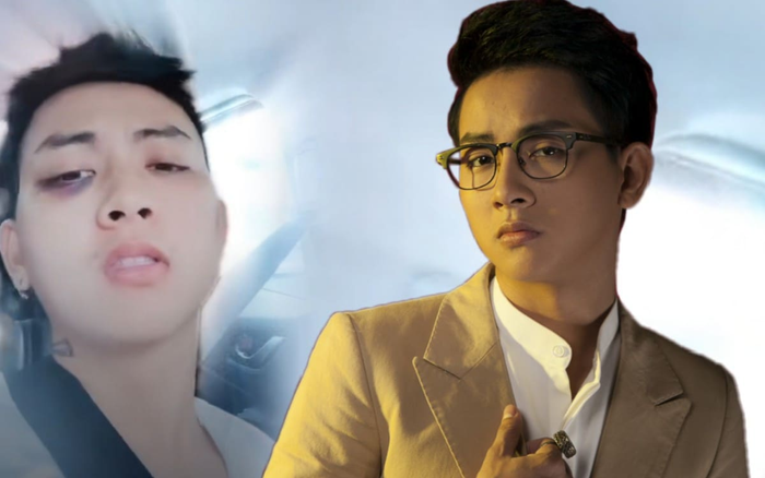 Hoài Lâm gây xôn xao khi xuất hiện với gương mặt bầm tím, biểu cảm khó hiểu càng khiến dân mạng hoang mang Ảnh 2